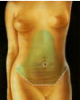 Vibrolipo - Abdminoplastia