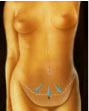 Vibrolipo - Abdminoplastia