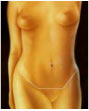 Vibrolipo - Abdminoplastia
